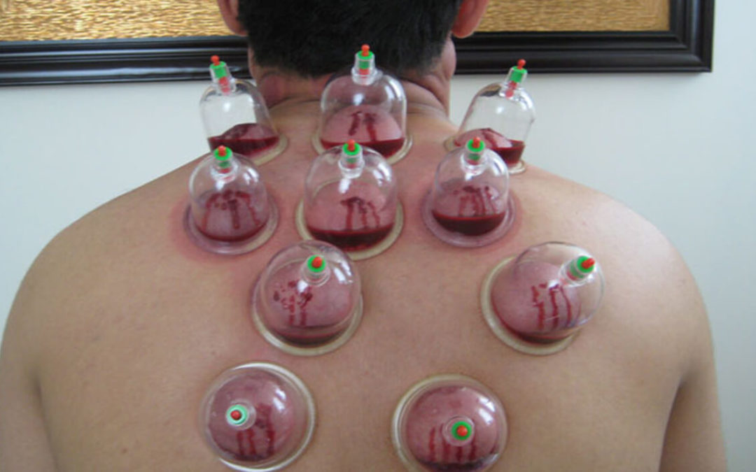 hijama for weight loss reviews