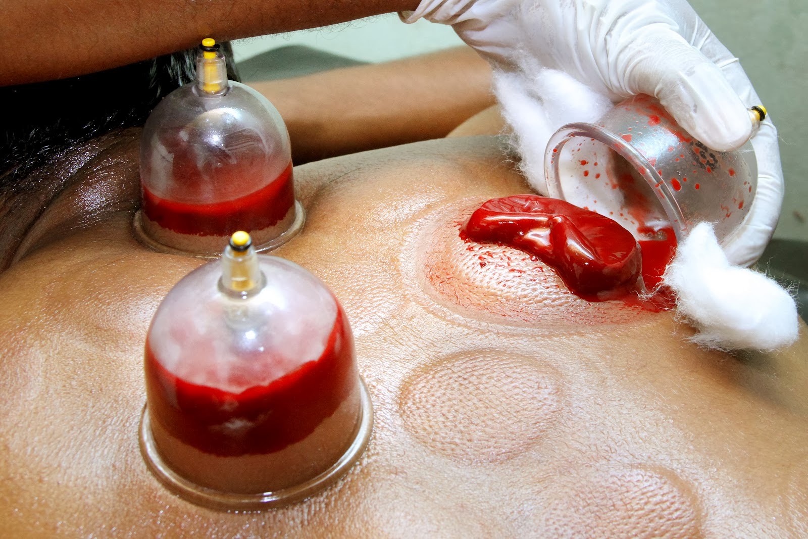 hijama for weight loss reviews